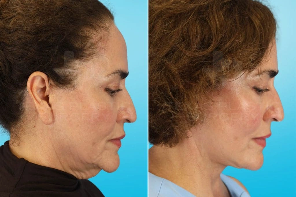 Real Patient results in San Antonio, TX Performed by Texas Plastic Surgery