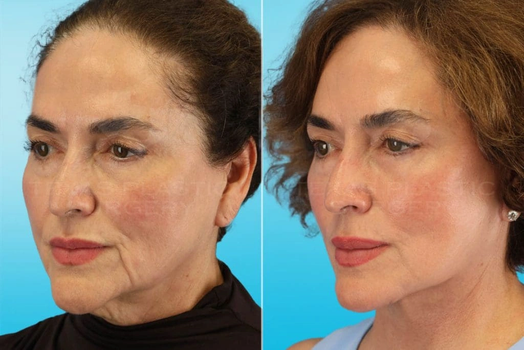 Real Patient results in San Antonio, TX Performed by Texas Plastic Surgery