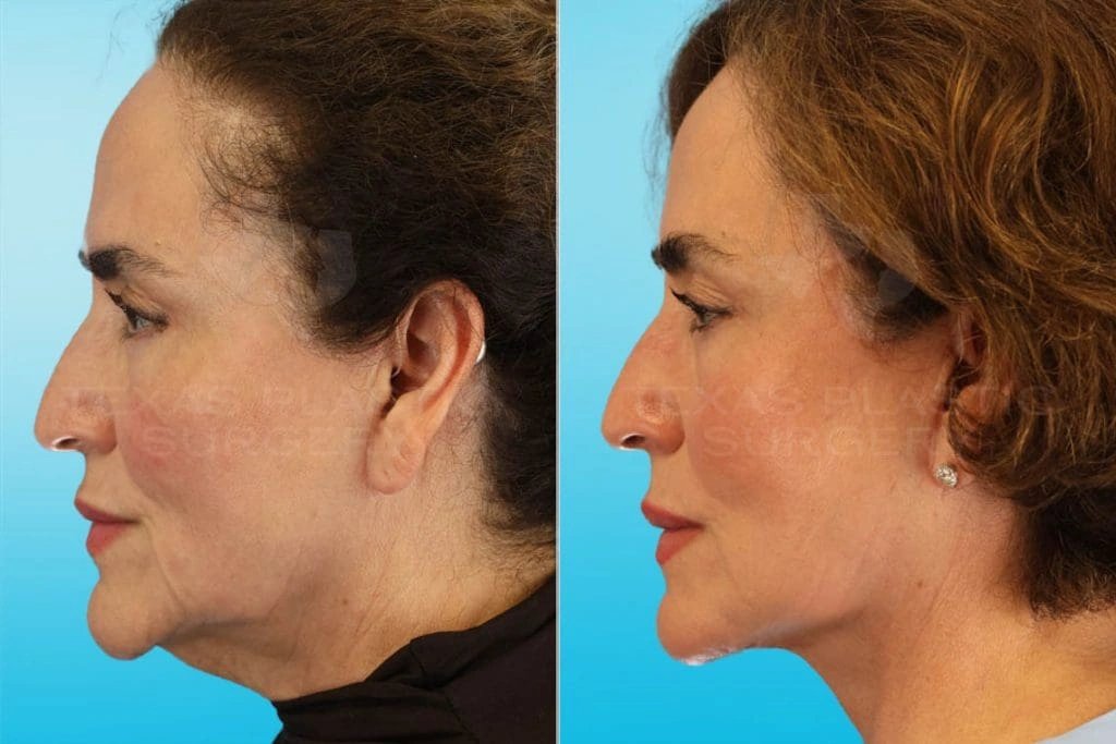 Real Patient results in San Antonio, TX Performed by Texas Plastic Surgery