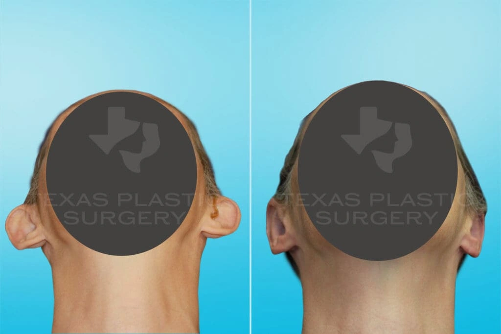 Real Patient results in San Antonio, TX Performed by Texas Plastic Surgery