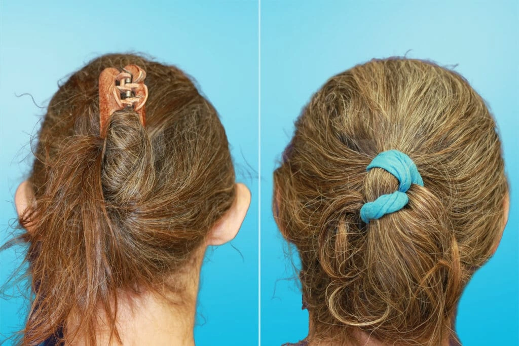 Real Patient results in San Antonio, TX Performed by Texas Plastic Surgery