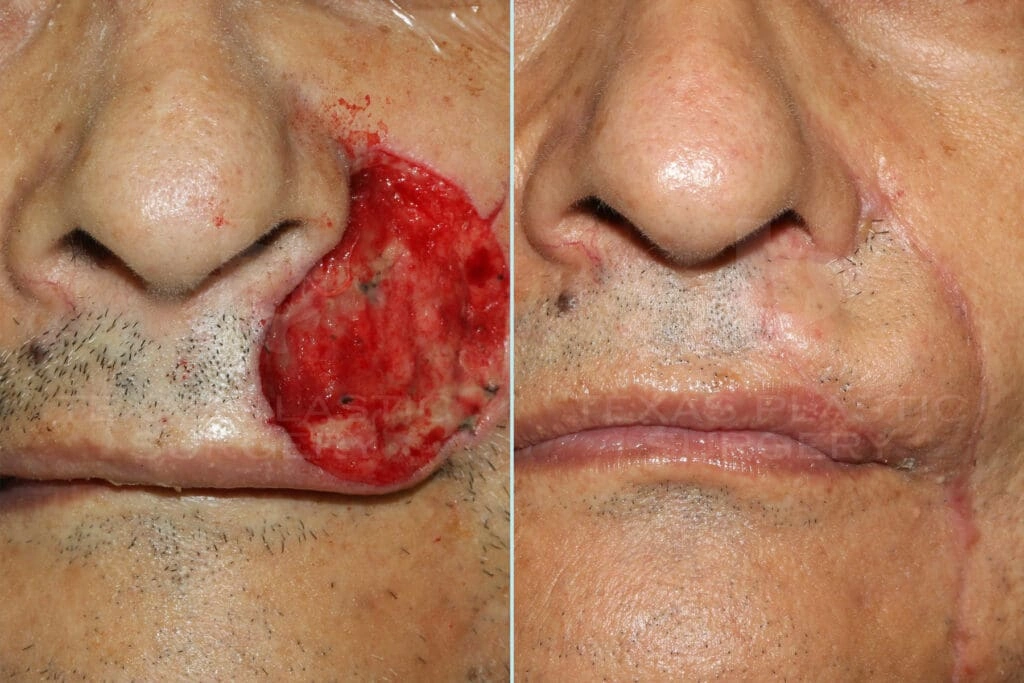 Real Patient results in San Antonio, TX Performed by Texas Plastic Surgery