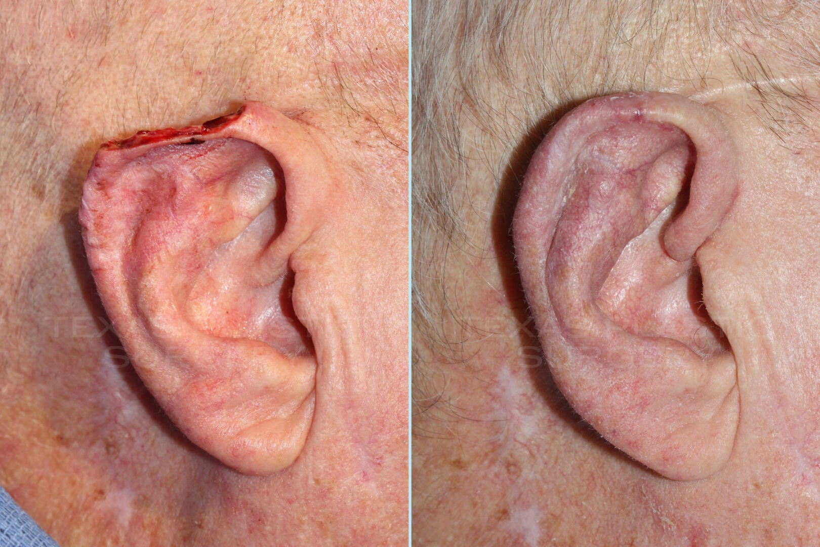 Real Patient results in San Antonio, TX Performed by Texas Plastic Surgery