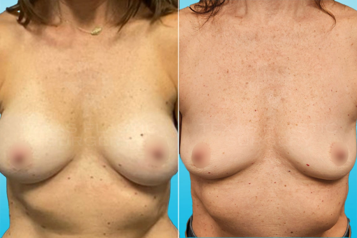 Real Patient results in San Antonio, TX Performed by Texas Plastic Surgery