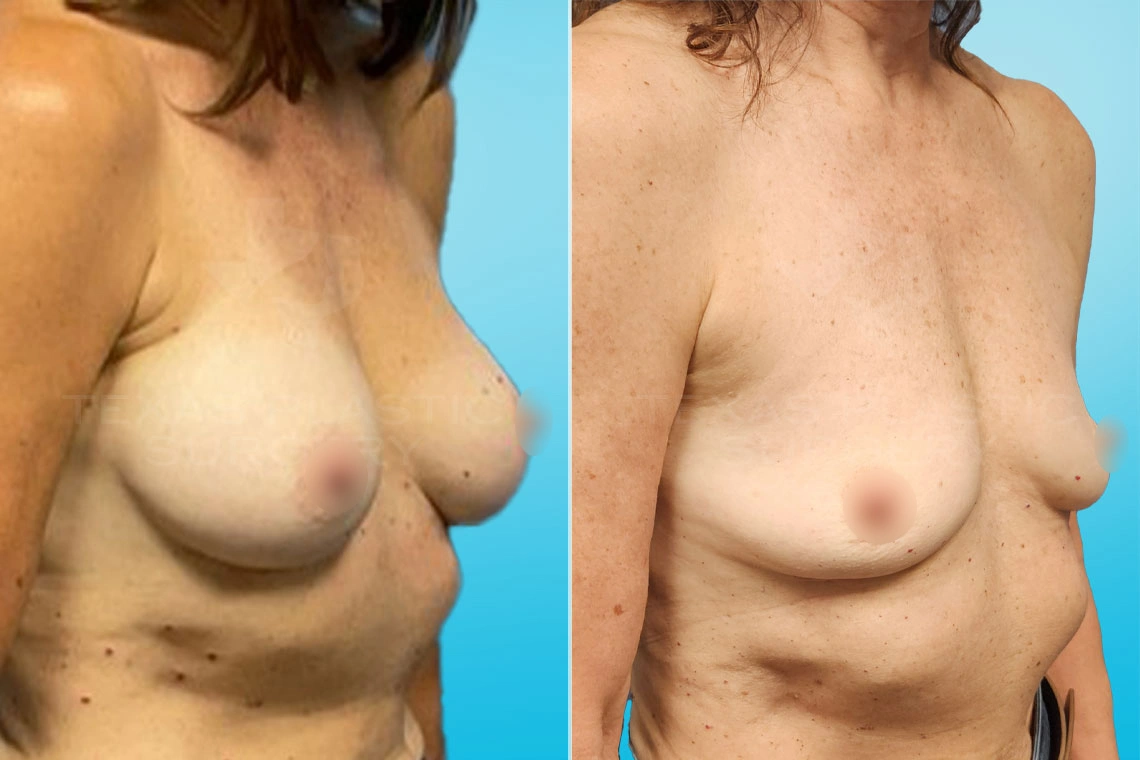 Real Patient results in San Antonio, TX Performed by Texas Plastic Surgery