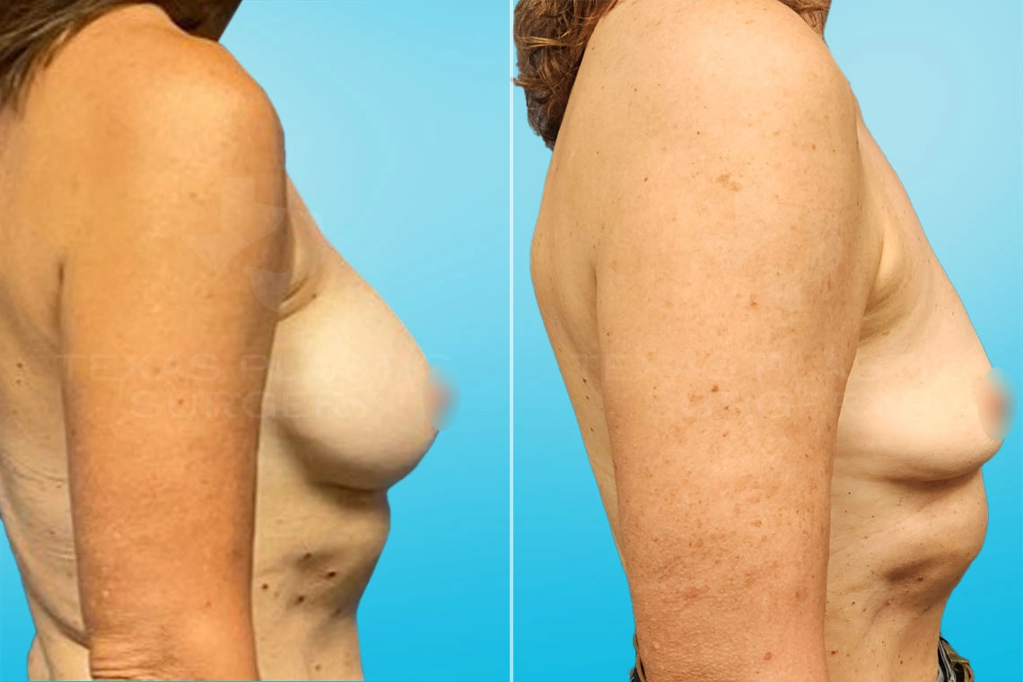 Real Patient results in San Antonio, TX Performed by Texas Plastic Surgery