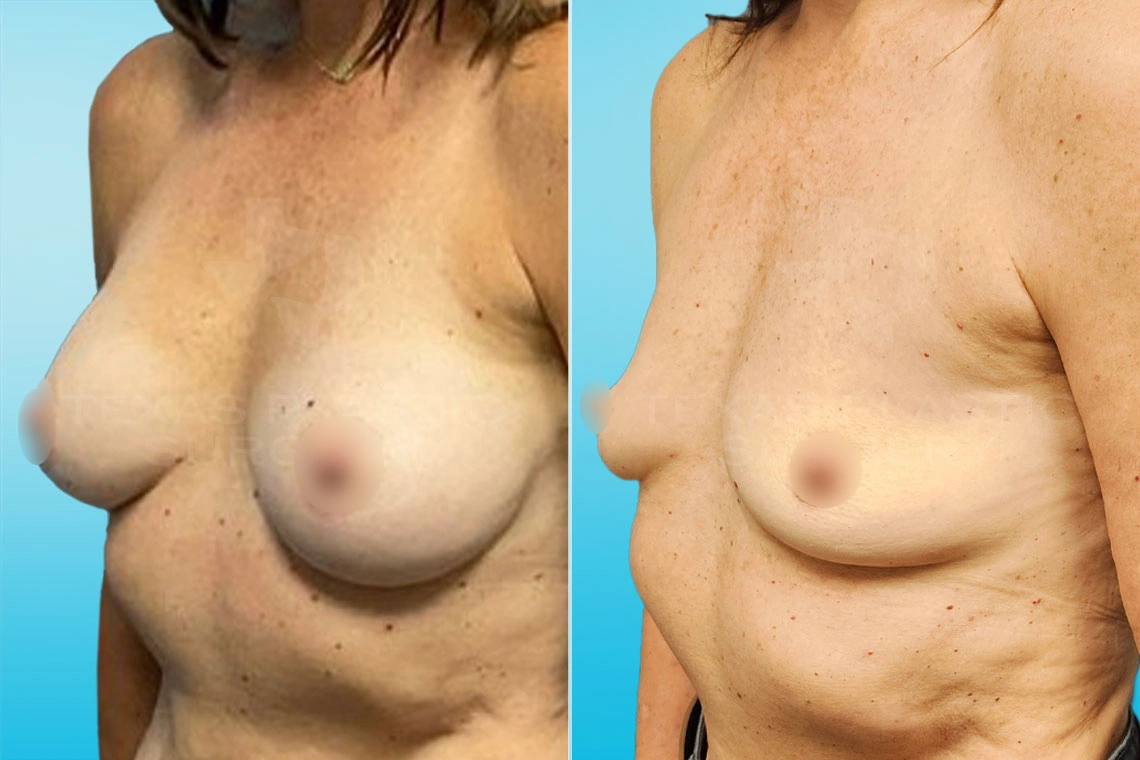 Real Patient results in San Antonio, TX Performed by Texas Plastic Surgery