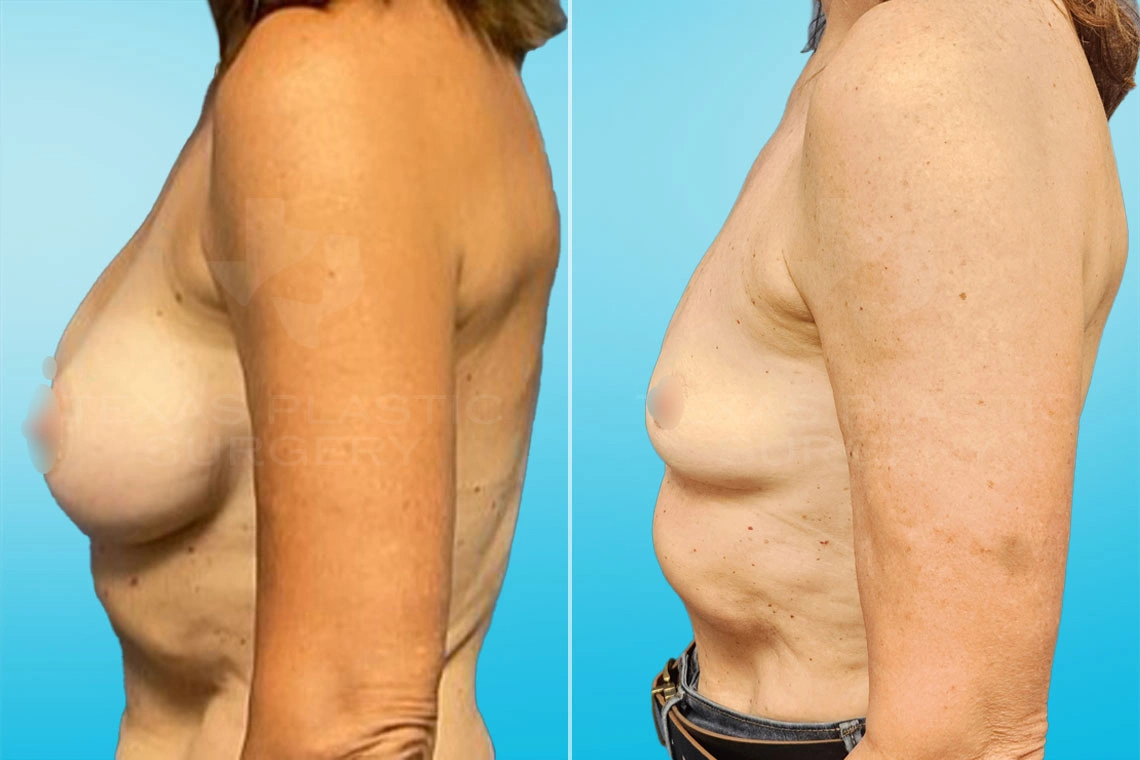 Real Patient results in San Antonio, TX Performed by Texas Plastic Surgery