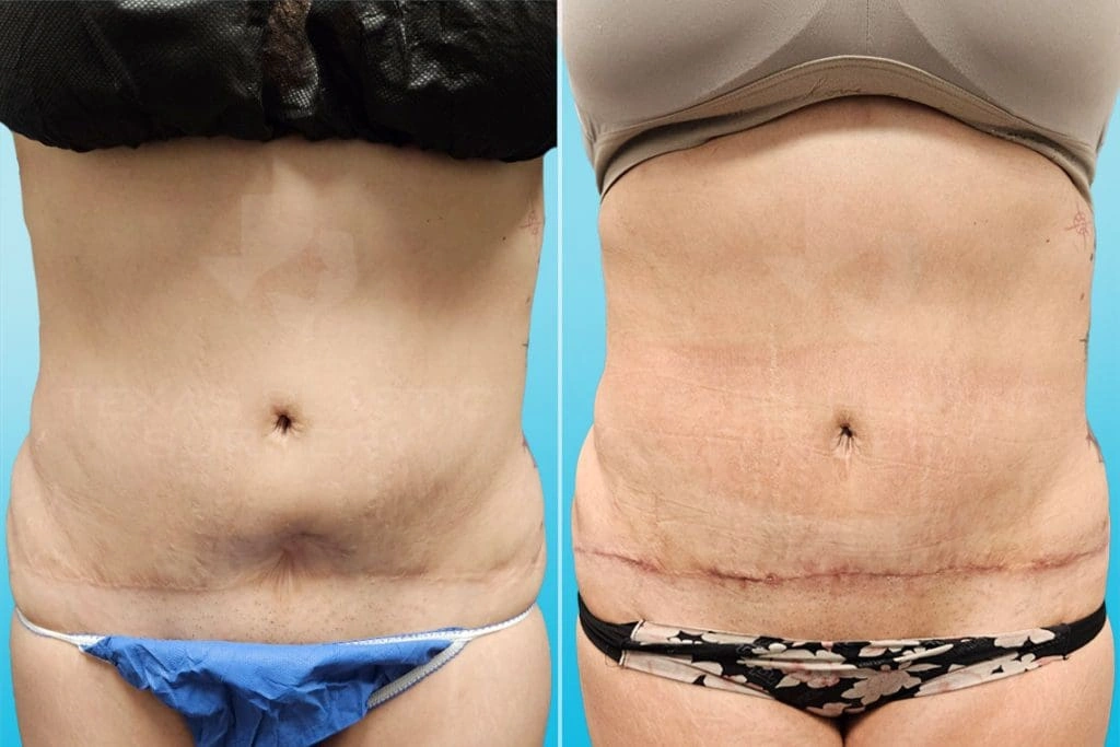 Real Patient results in San Antonio, TX Performed by Texas Plastic Surgery