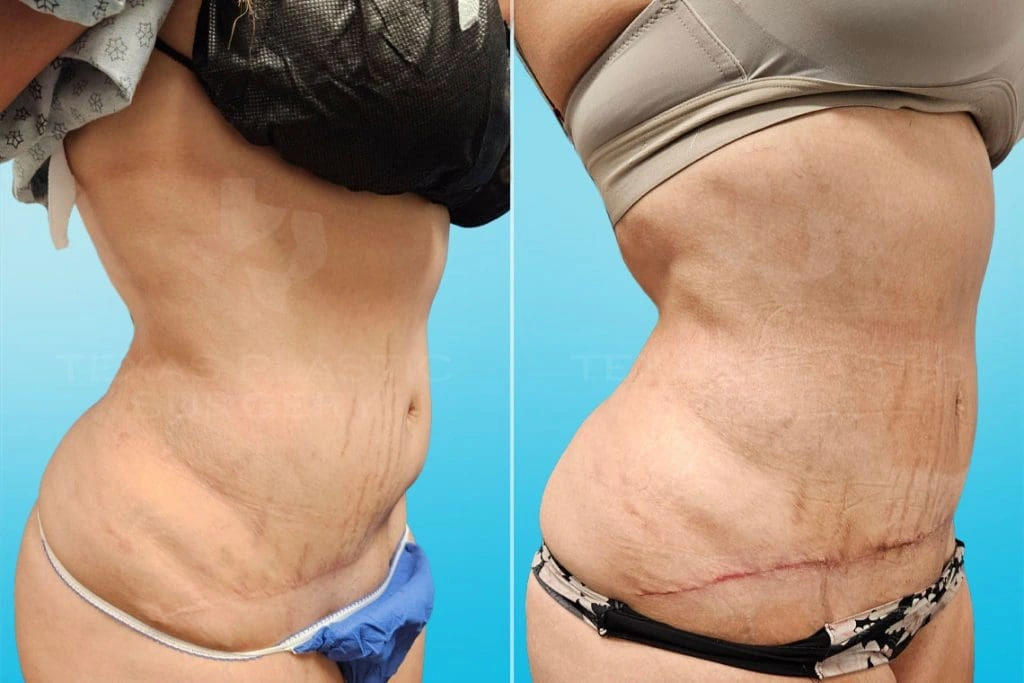 Real Patient results in San Antonio, TX Performed by Texas Plastic Surgery