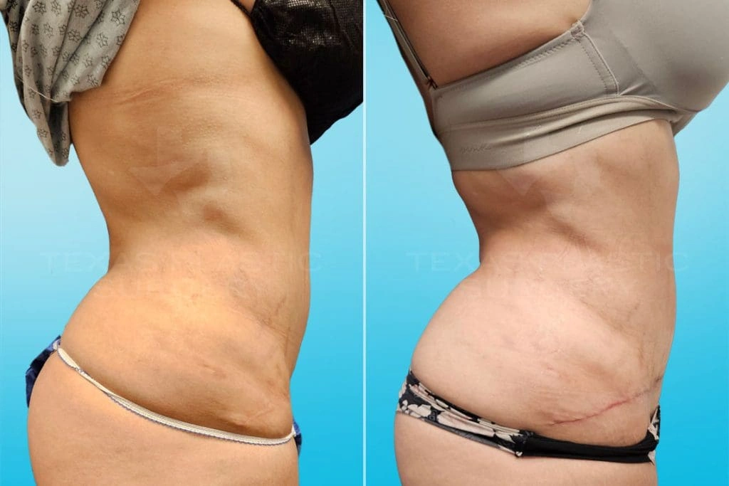 Real Patient results in San Antonio, TX Performed by Texas Plastic Surgery