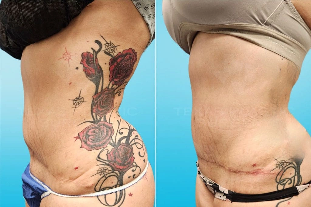 Real Patient results in San Antonio, TX Performed by Texas Plastic Surgery