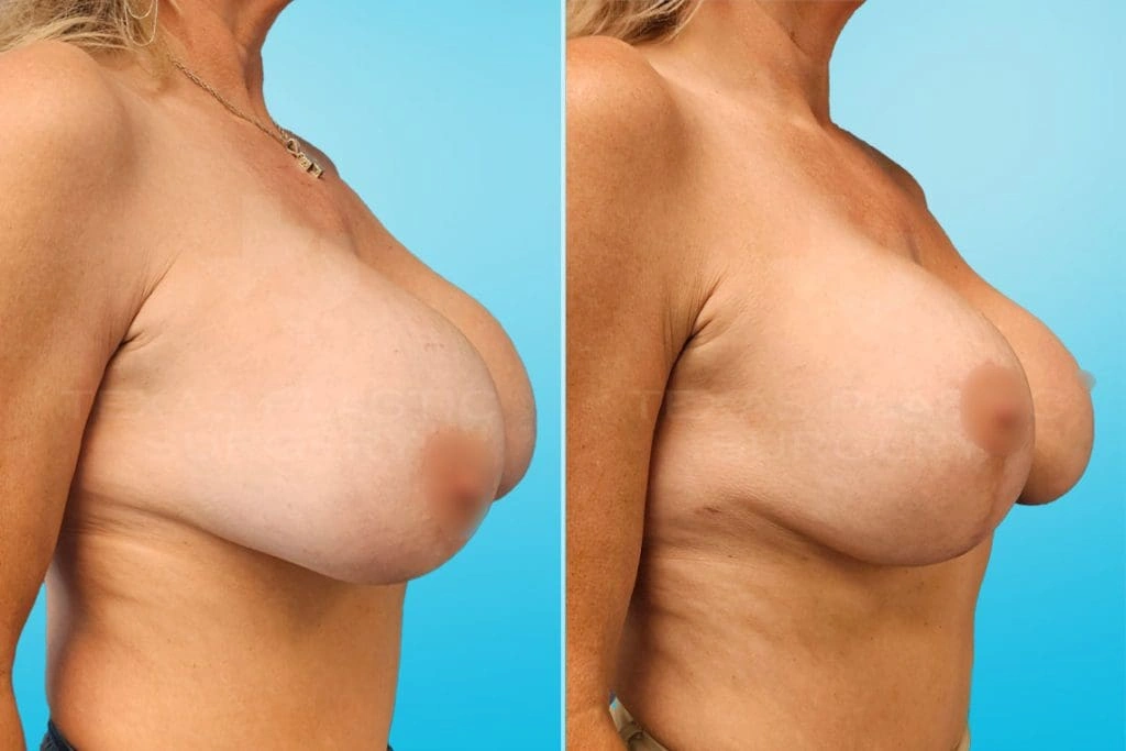 Real Patient results in San Antonio, TX Performed by Texas Plastic Surgery