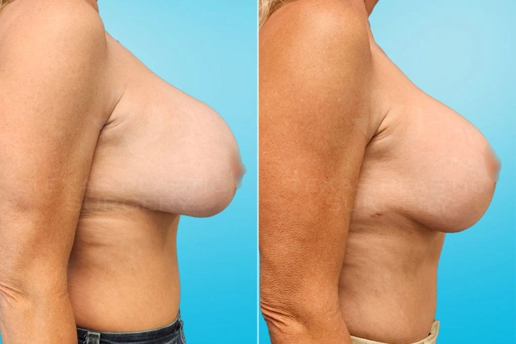 Real Patient results in San Antonio, TX Performed by Texas Plastic Surgery