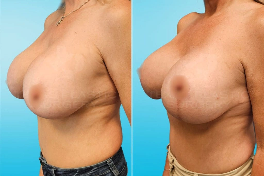Real Patient results in San Antonio, TX Performed by Texas Plastic Surgery