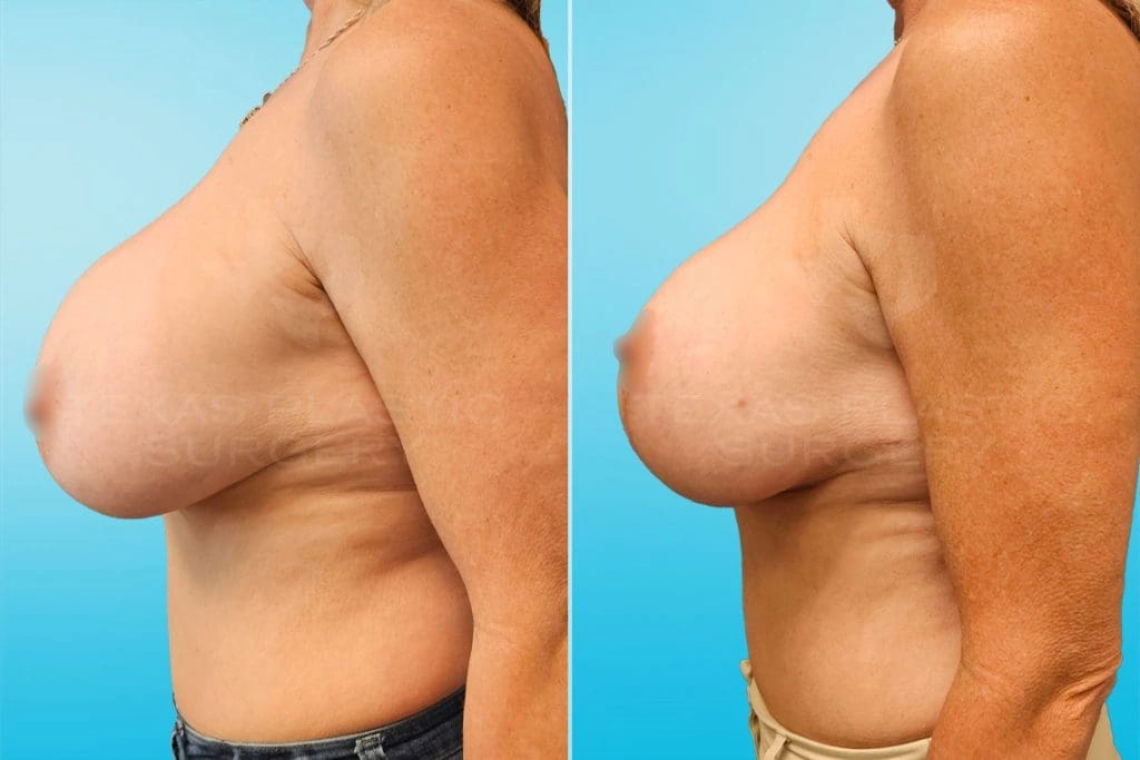 Real Patient results in San Antonio, TX Performed by Texas Plastic Surgery