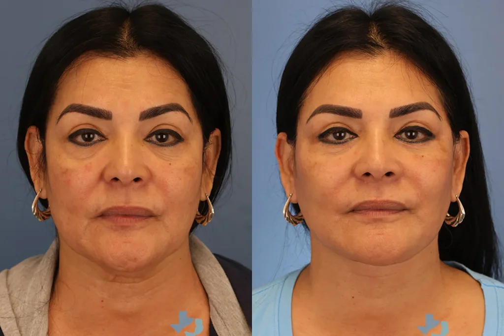 facelift 1