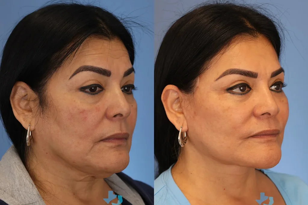 facelift 2