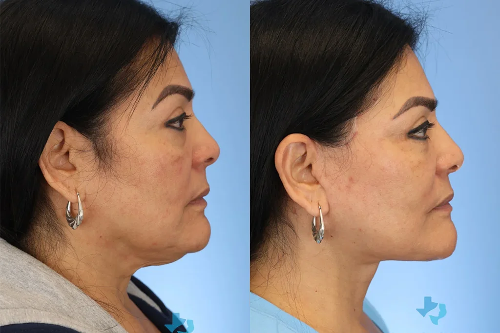 facelift 3