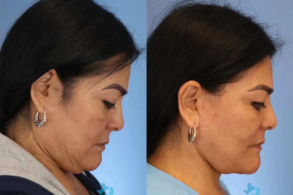 facelift 4