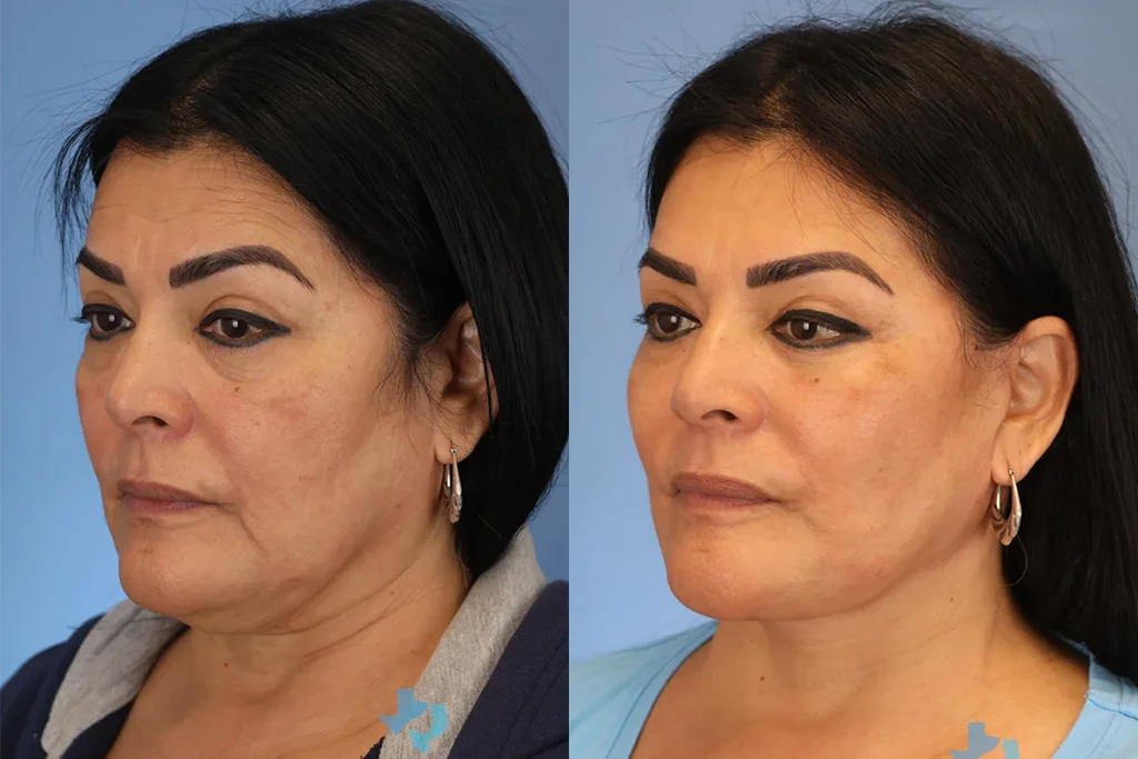 facelift 5