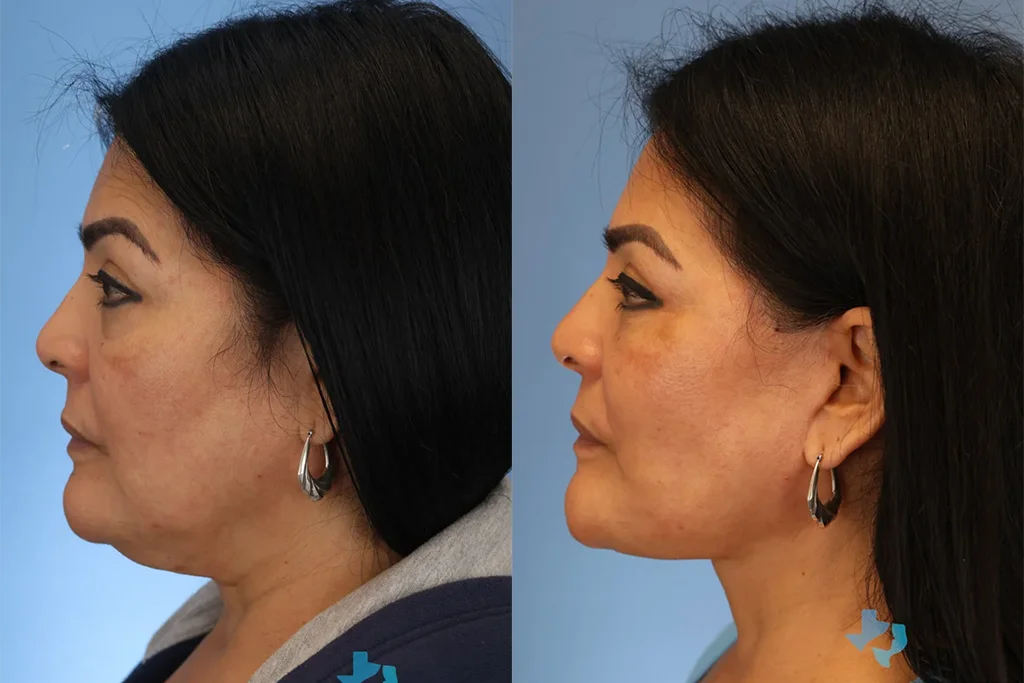 facelift 6