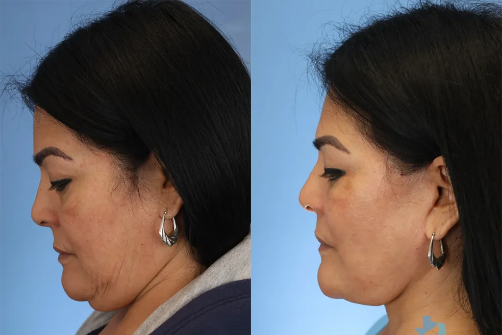 facelift 7